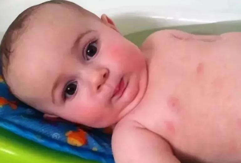 孩子得了湿疹应如何治疗与管理,父母都有湿疹怎么避免孩子湿疹