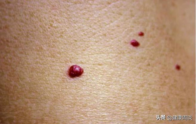 红色的蜘蛛痣咋回事,肝病蜘蛛痣出现是早期还是晚期