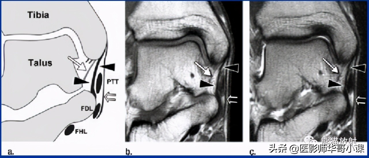 踝关节解剖视频课,解剖学韧带分布图