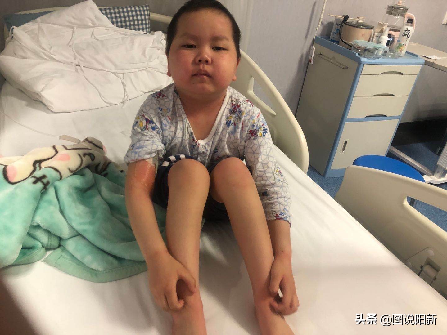 肿瘤儿童化疗期间脑萎缩,化疗后脑萎缩变傻了