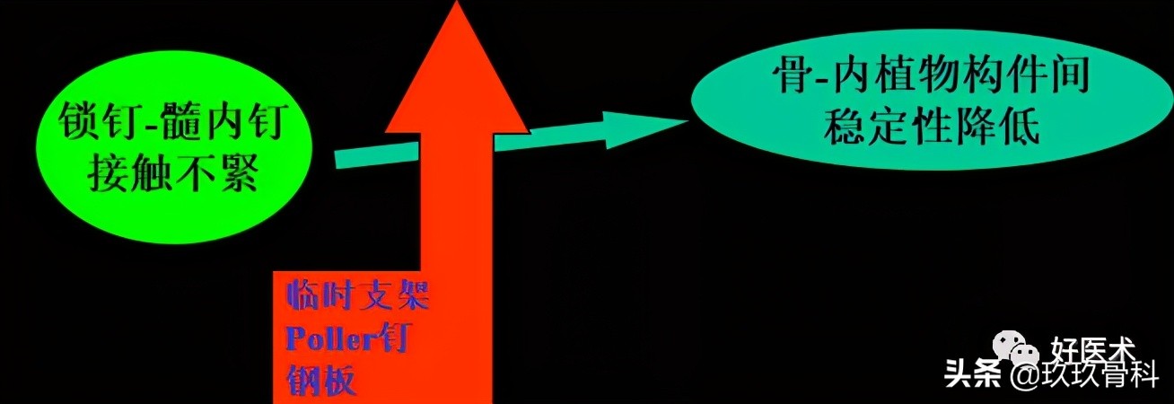 髓内钉技巧,髓内钉教学视频讲解