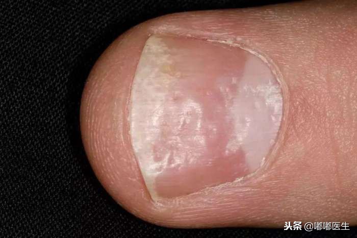指甲有白点肚子里有蛔虫？月牙越大越健康？指甲软是缺钙……