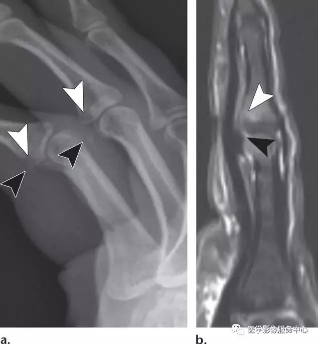 手腕撕脱性骨折一年了还隐隐作痛,手腕三角骨撕脱骨折症状有哪些