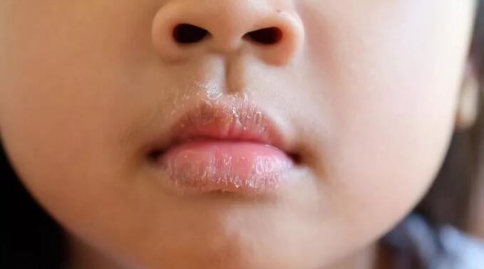 小孩长期嘴唇干裂起皮还出血,儿童嘴唇起皮干裂出血怎么办