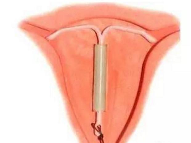 取环该做哪些准备,取环后多久可以备孕二胎