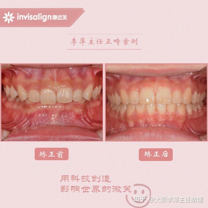 太原矫正牙齿需要做正颌吗,太原牙齿二次矫正
