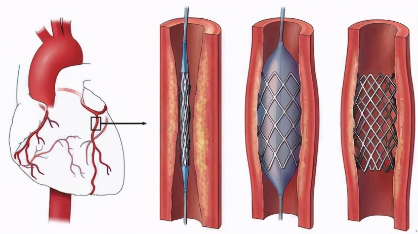 心脏支架选择哪种支架好,心脏支架与搭桥的利与弊