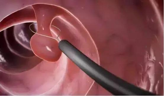 肠镜检查可以直接切除息肉吗,肠镜检查20多个息肉严重吗