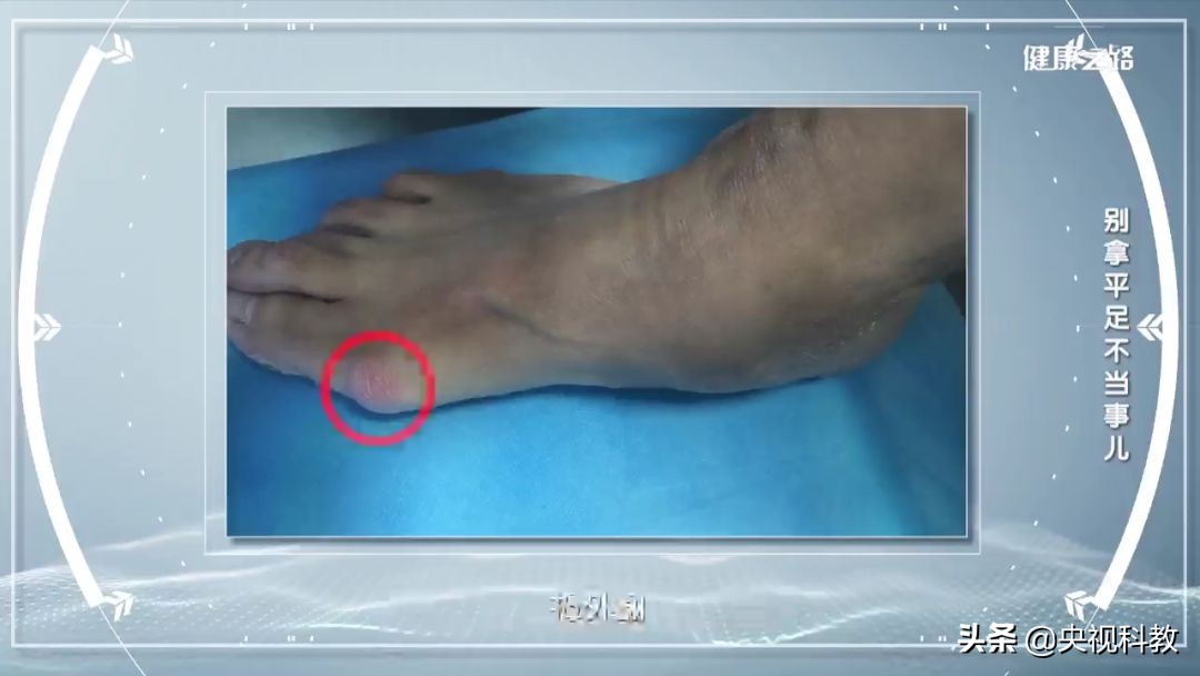 腰疼引起腿和脚麻是怎么回事,经常腰痛原来是脚的问题