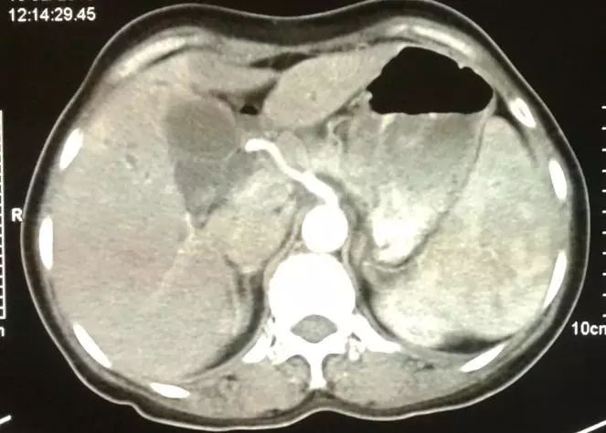 吃虫子减肥,减肥吃虫子的方法