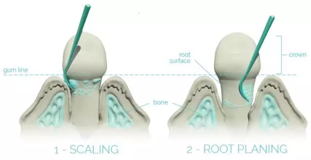 深层洗牙和一般洗牙有什么区别,为什么洗牙价格有便宜有贵的
