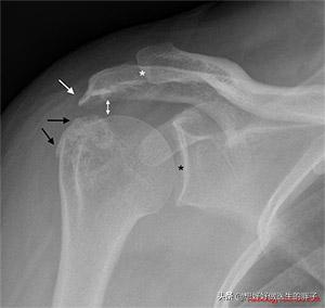左肩疼痛是什么病的预兆,左肩疼痛要警惕什么病