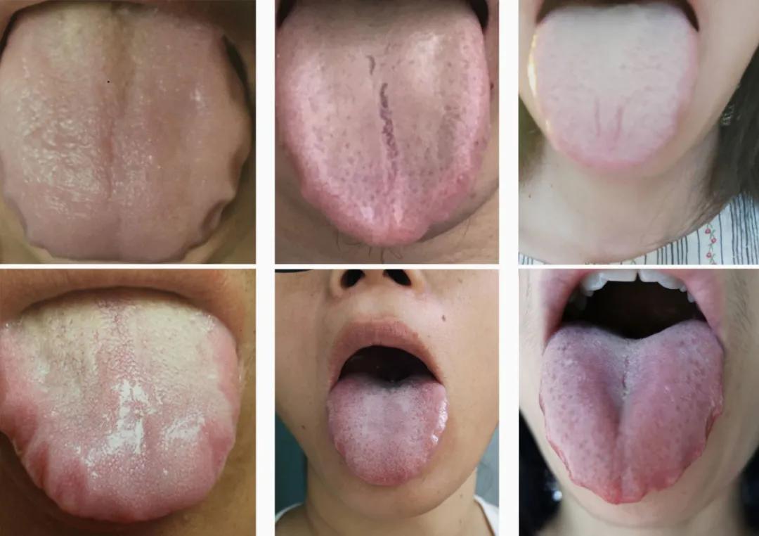 中水毒是什么原因引起的,中水毒了怎么办