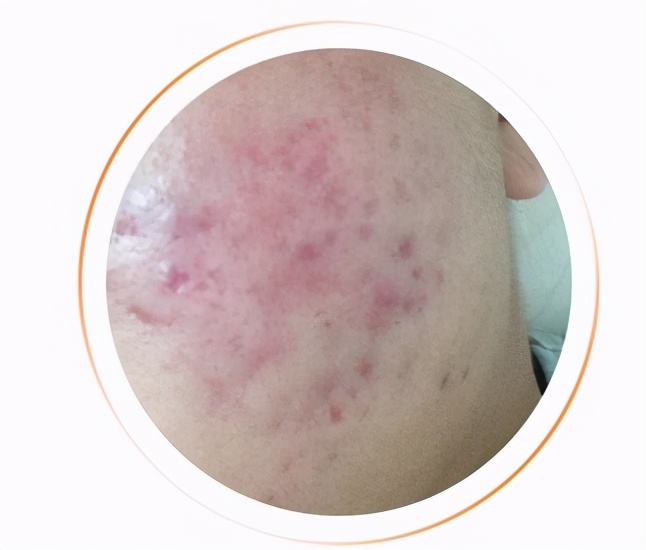 祛除疤痕痘印痘坑药膏,祛除痘印痘坑护肤品