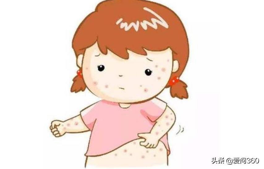 荨麻疹遇热重遇冷缓解怎么治,麻疹出现皮肤瘙痒用什么止痒