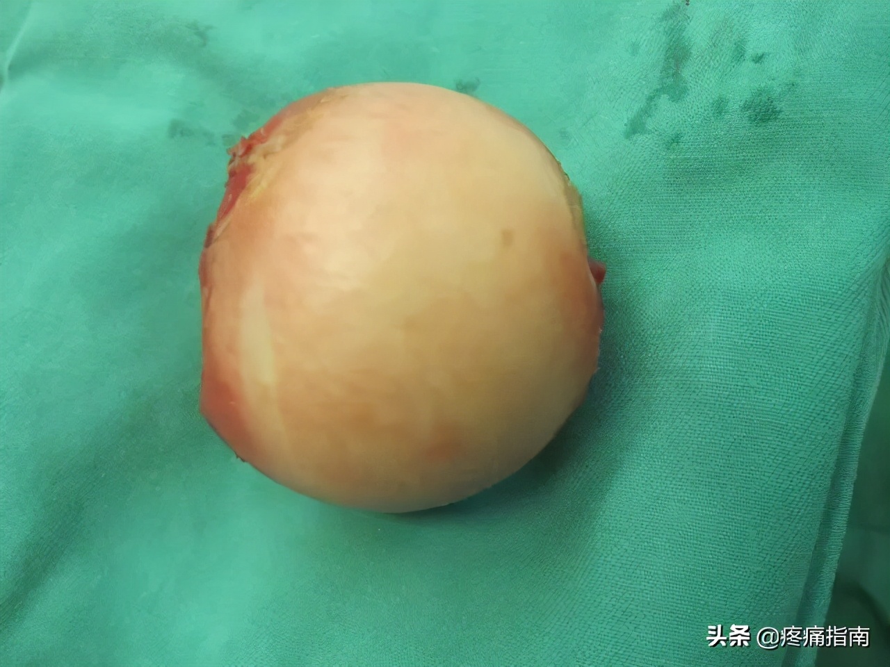 夏天无注射液能治疗骨头坏死吗,骨头坏死用针刀镜有用么