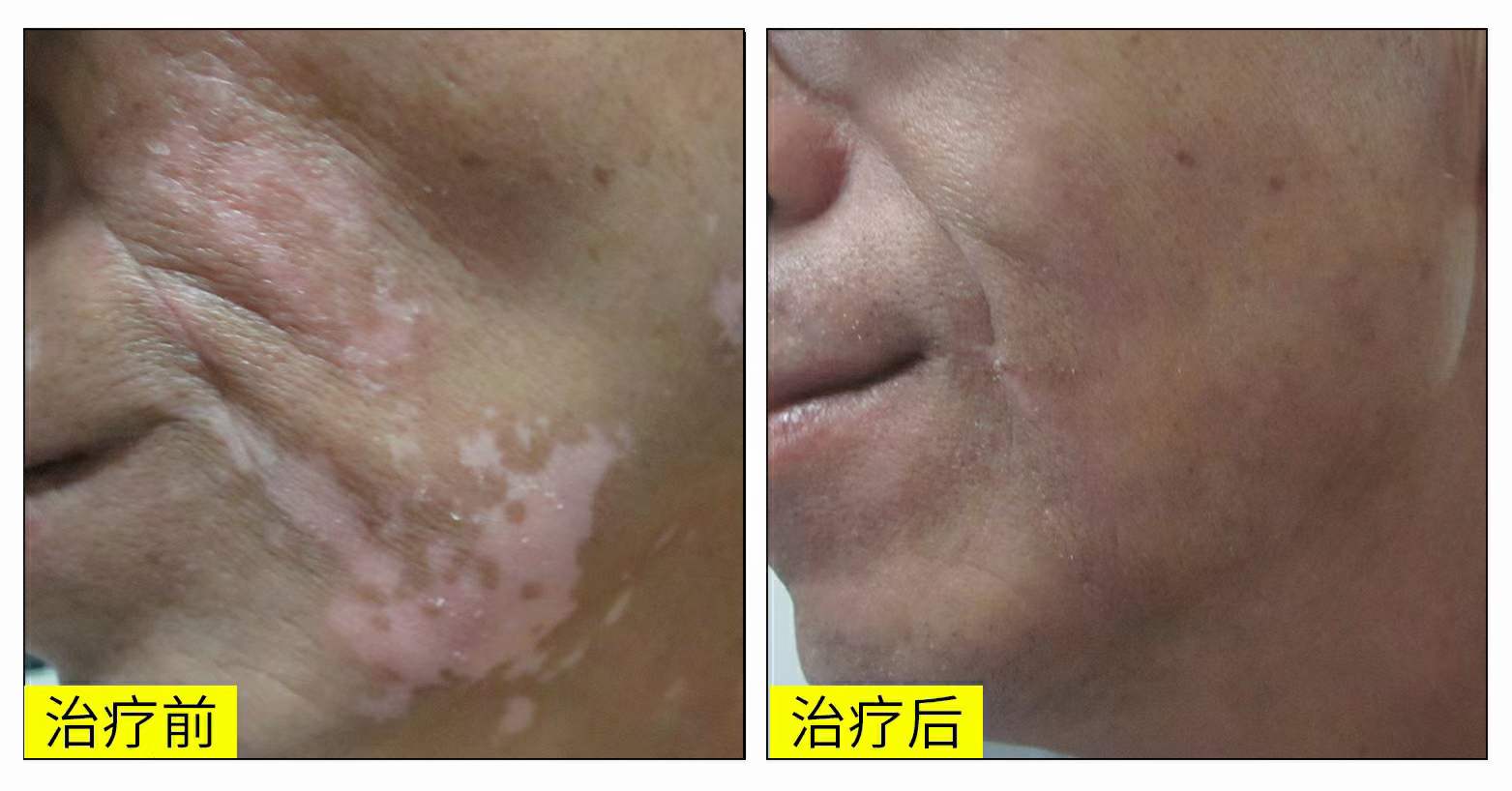 白癜风prp疗法多长时间一个疗程,白癜风光疗一个疗程需要做多少次