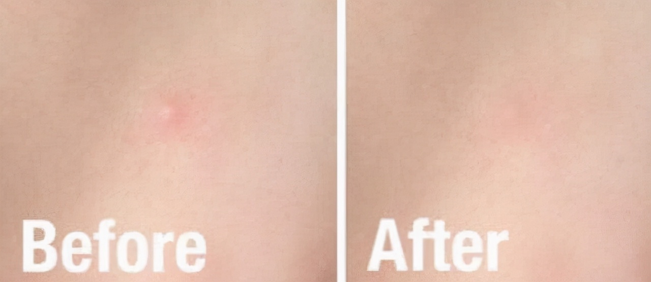 珂语祛痘印痘坑多久有效,珂语面膜测评