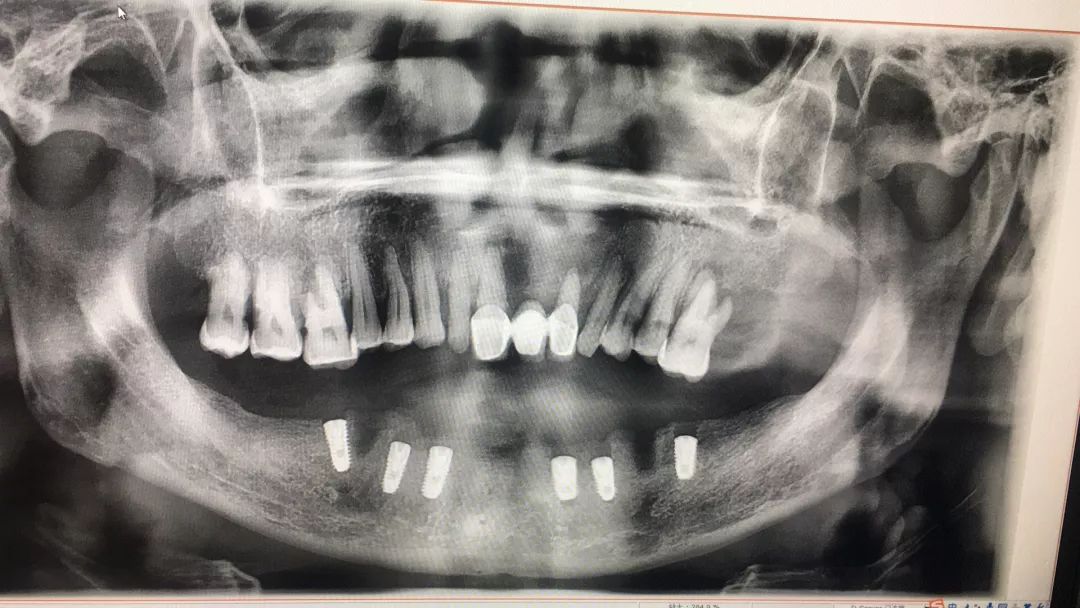 天津中诺口腔医院种牙多少钱一颗,苏州哪家种牙性价比高的