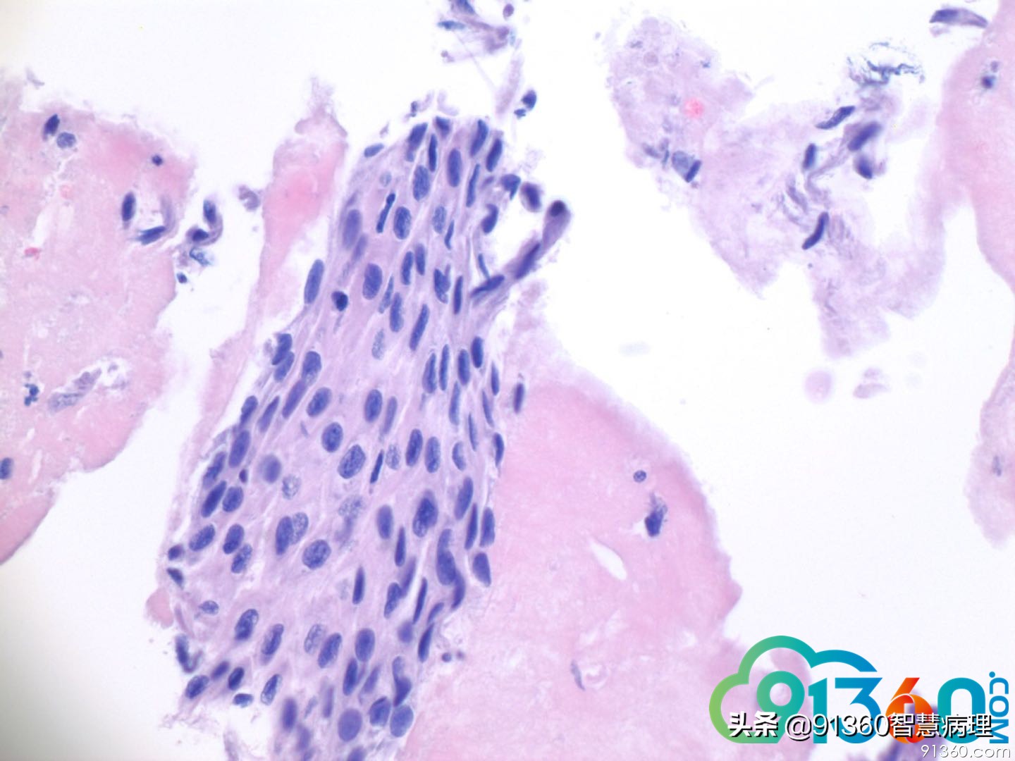 宫颈病理tct是什么检查,tct出现ascus会是宫颈癌吗