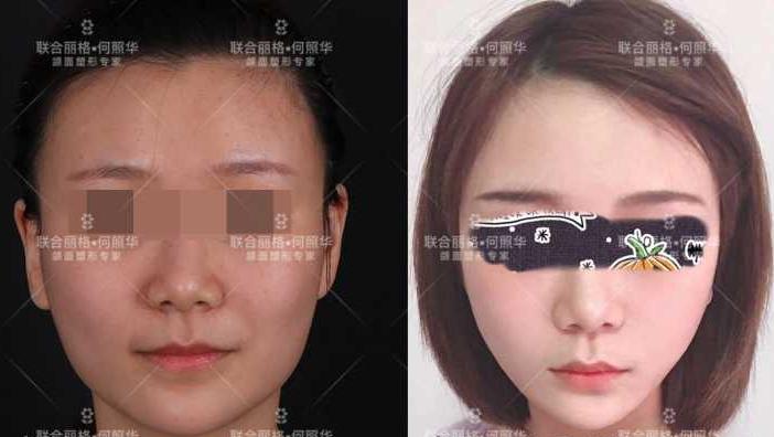 哪个明星做了颧骨内推,颧骨内推明星前后对比