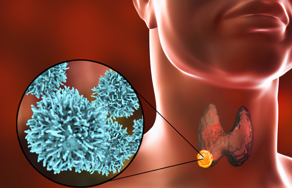 甲状腺结节偏囊肿应该怎么办,甲状腺胶质潴留囊肿和甲状腺结节