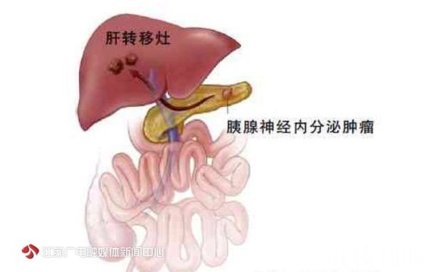 经常拉肚未必是肠胃炎！这种罕见病带走了“苹果之父”乔布斯