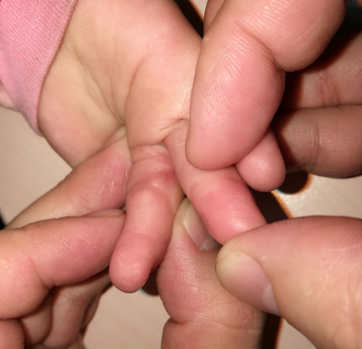 并指畸形免植皮案例,并指畸形