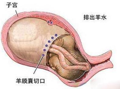 羊水栓塞的高危因素有哪些,羊水栓塞指南最新解读