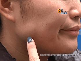 打完瘦脸针青蛙腮正常吗,打完瘦脸出现青蛙腮