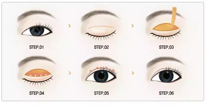 双眼皮眼袋手术揭秘,双眼皮手术时最全攻略