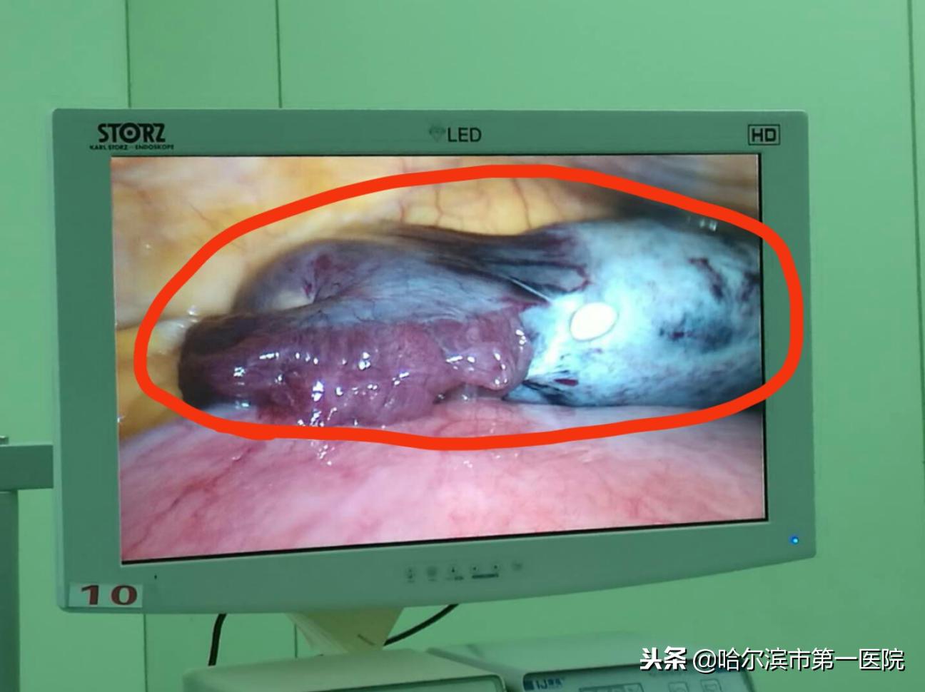 卵巢囊肿7cm扭转怀孕了,怀孕7周做卵巢囊肿扭转微创