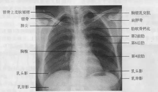 拿到胸片却不会看？送你7个窍门，手把手教你解读胸片（收藏）