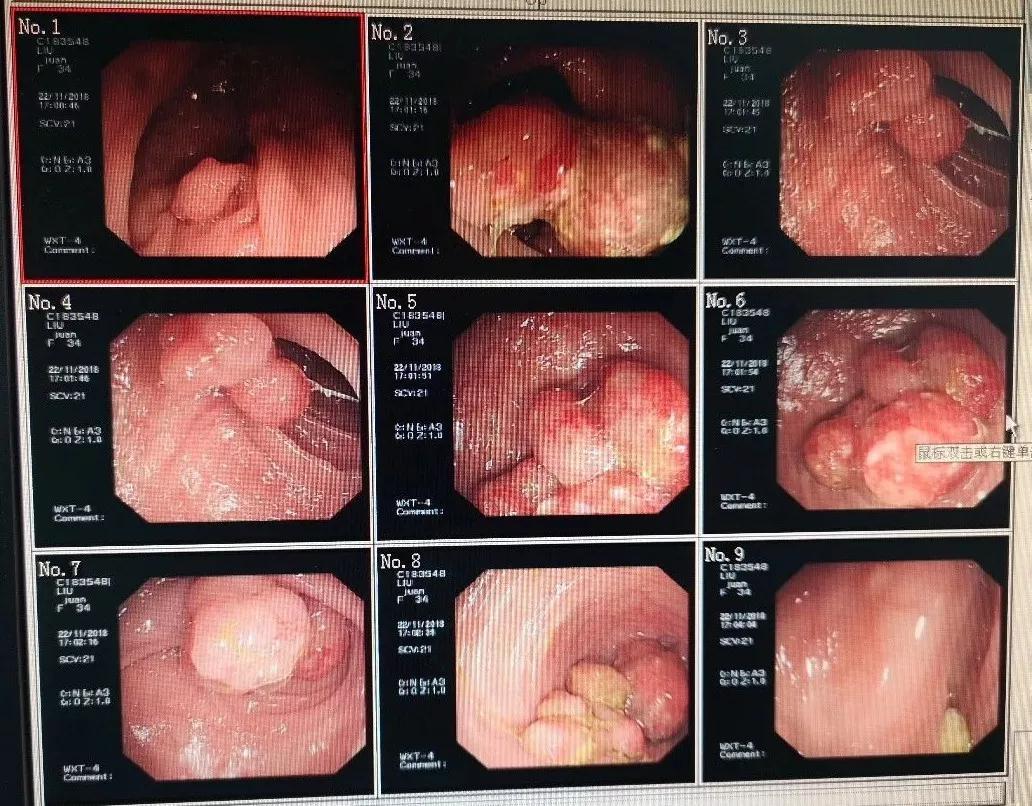 肠道息肉嘴唇黑斑,嘴唇上有黑点是肠道息肉吗
