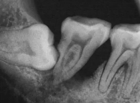 有没有智齿不拔的案例,我有个智齿没长出来怎么拔