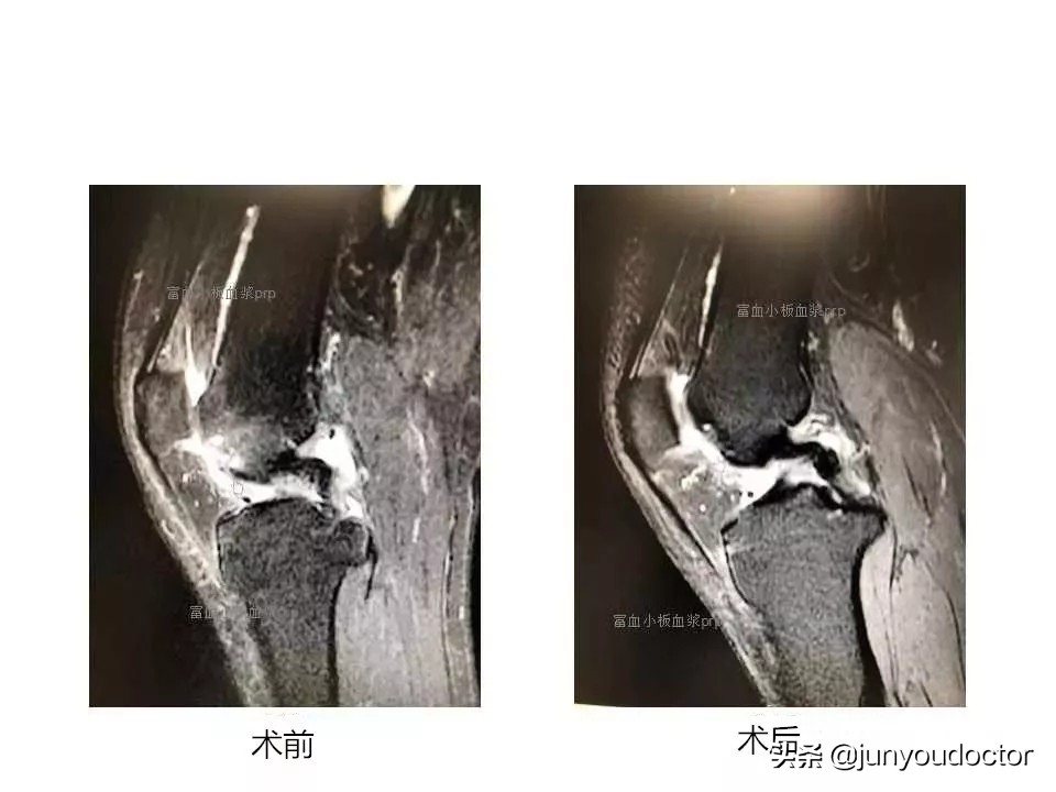 我(PRP)的超能力是富予人体超强自愈力