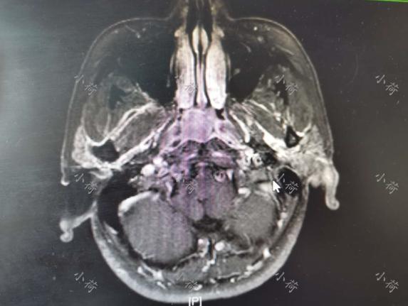 鼻咽癌治愈5年后流鼻血,从小到大流鼻血确诊鼻咽癌