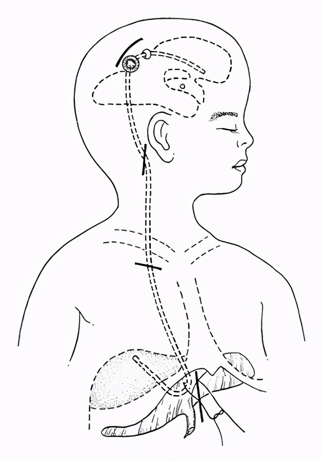 脑子里有水危险吗后果怎样,脑子里面有水是真的吗