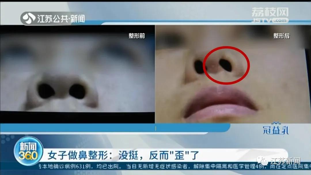整容后鼻子越来越歪,整容鼻头歪斜