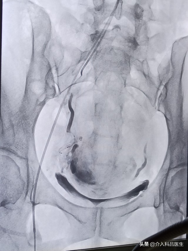 不死的癌症子宫腺肌瘤,子宫腺肌症介入栓塞效果和后遗症