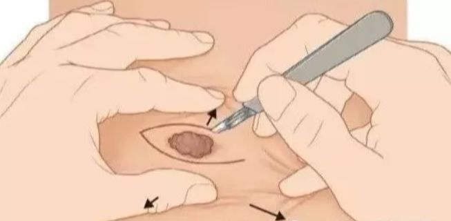 中医点痣最好方法,中医古方中草药点痣