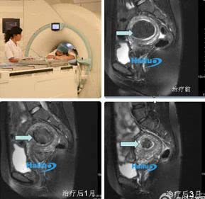 多发性肌瘤必须做子宫切除手术吗,10公分大肌瘤能微创手术吗