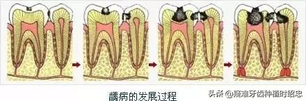 治牙费用一般多少钱,儿童治牙费用