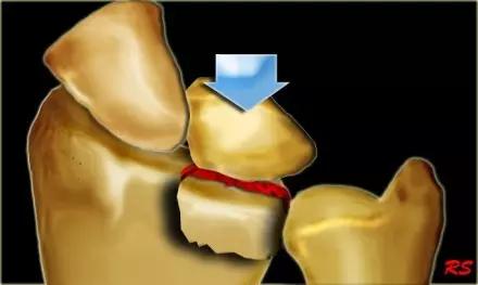 特殊骨折类型,特殊骨折体征