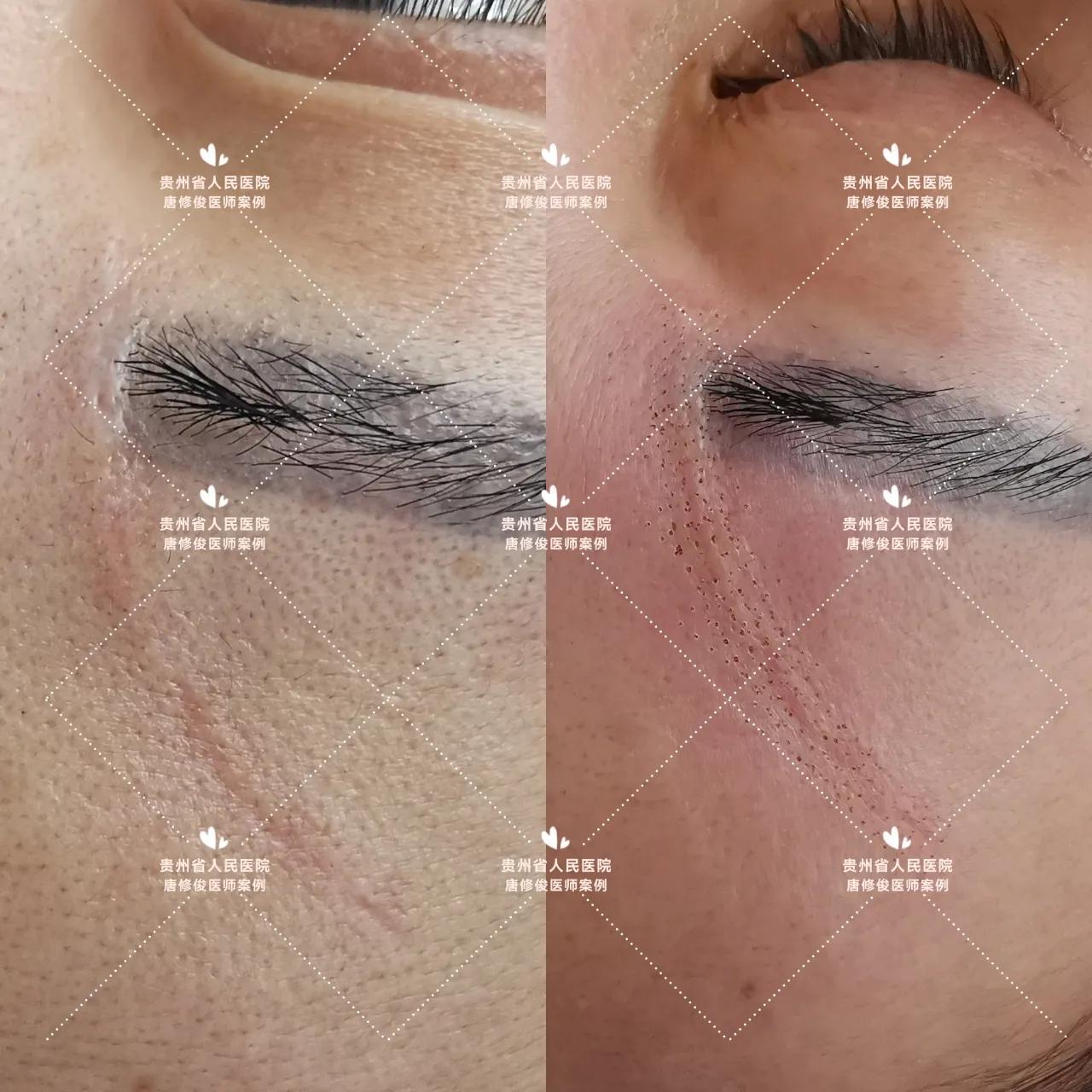 点阵激光祛疤痕增生会复发不,点阵激光治疗疤痕有效吗