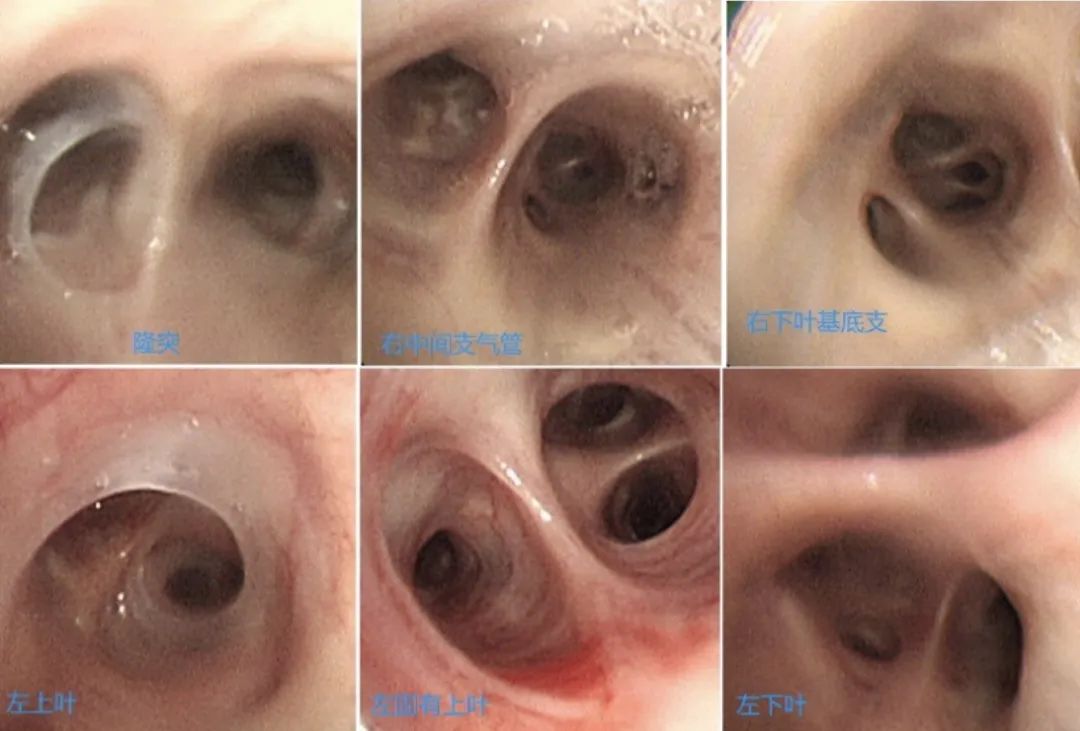时隔一年再次住院,时隔一年旧病复发