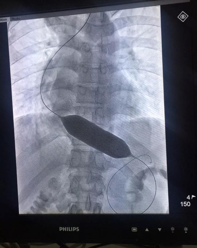 贲门吞咽困难怎么办,吞咽困难咽不下去怎么办