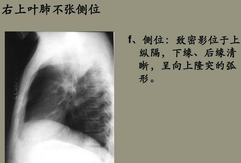 x线诊断边界模糊,x线诊断有误区吗