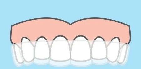 所有矫正都要戴保持器吗,成年人矫正牙齿需要戴保持器多久