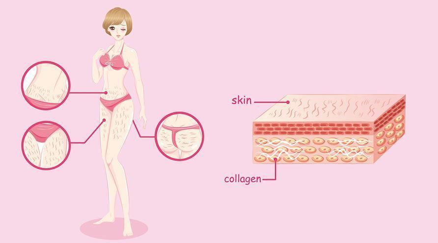 肥胖纹真的是因为肥胖而导致的吗,比胖更可怕的是松弛和下垂